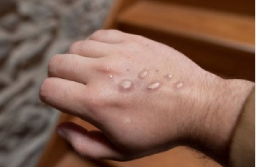 Viruela del mono. Alerta mundial